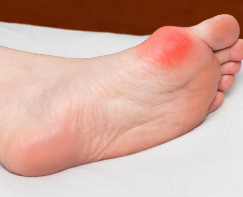 A gyulladt bütyök fájdalom ábrázolása piros színnel