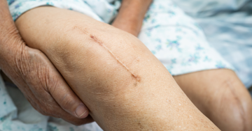 A képen egy idős ember térdén látható műtéti heg, amely belső hegesedést is jelezhet. A heg utalhat a műtét utáni regenerációs folyamatokra, ahol a bőr alatt tapasztalható szöveti letapadás és feszülés is kialakulhat.