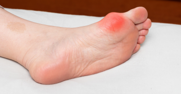 A gyulladt bütyök fájdalom ábrázolása piros színnel