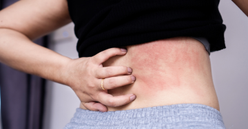 Kezdődő felfekvés tünetei: kipirosodott bőr és érzékenység