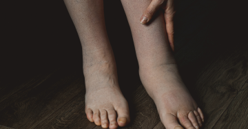 Nyiroködéma tünetei a lábon: duzzanat és feszülés