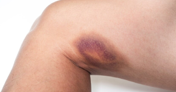 zúzódás safe laser