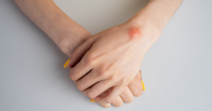 Csuklón megjelenő ganglion – tapintható duzzanat