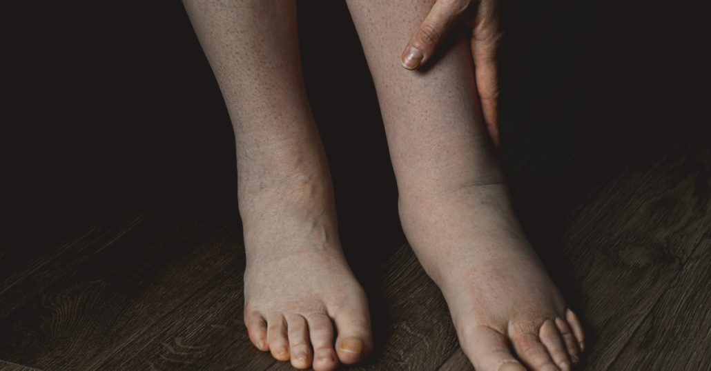 Nyiroködéma tünetei a lábon: duzzanat és feszülés