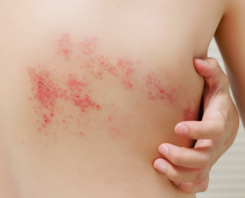 Övsömör tünetei: jellegzetes egyoldali kiütés a háton, az övsömör kezelése előtt